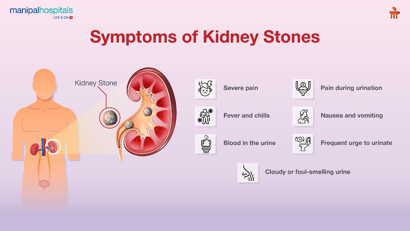 Symptoms of kidney stones