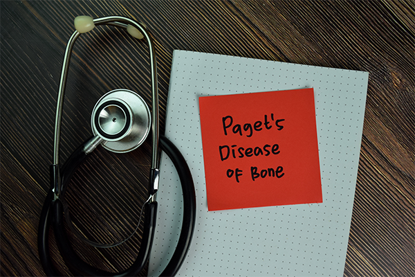 Paget’s disease of bone X-ray showing bone deformity