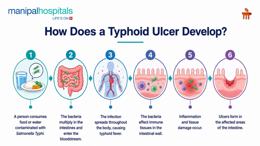 typhoid-ulcer-symptoms-and-treatment-guide