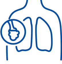 ARDS: Symptoms, Causes & Treatment
