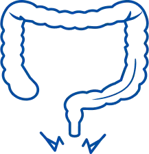 Anal Fissure