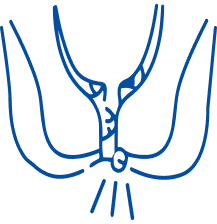 Fistula Treatment in Pune | Manipal Hospitals