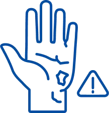 Chemical Burns: Symptoms & Treatment