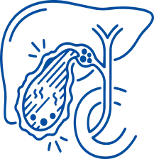 Cholecystitis: Symptoms, Causes & Treatment