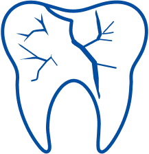 Cracked Teeth Treatment in Kolkata | Manipal Hospitals
