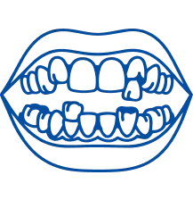 Crowded Teeth: Causes & Treatment