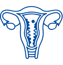 Endometrial Cancer: Symptoms & Treatment | Manipal Hospitals