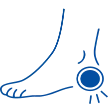 Heel Spurs: Symptoms, Causes & Treatment