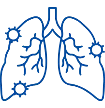 IPF Treatment in Bangalore | Manipal Hospitals