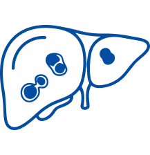 Liver Tumors: Symptoms & Treatment