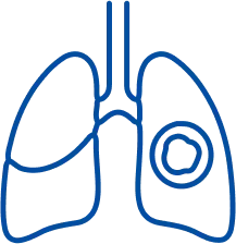 Lung Mass: Symptoms, Causes & Treatment