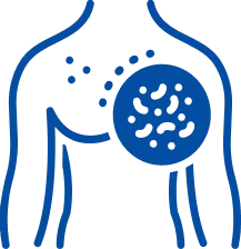 Lymphoma Treatment in Bangalore | Manipal Hospitals