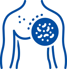 Lymphoma Treatment in Delhi | Manipal Hospitals