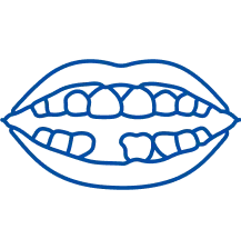 Missing Teeth: Causes & Treatment Options