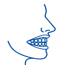 Overbite: Symptoms, Causes & Treatment
