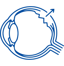 Retinal Detachment: Symptoms & Treatment