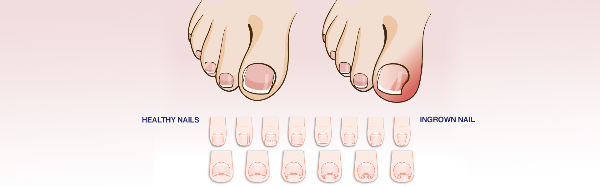 ingrown Toe Tail Treatment in Bangalore 