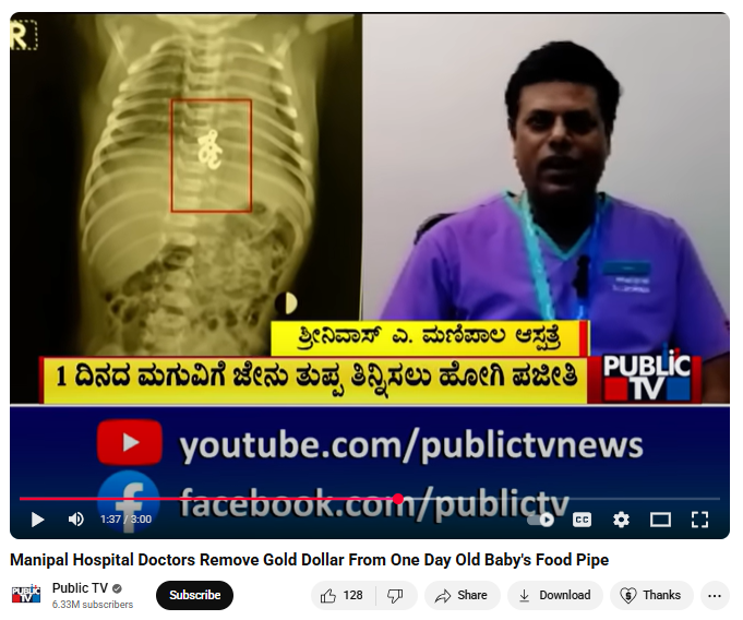 Manipal Hospital Doctors Remove Gold Dollar From One Day Old Baby's Food Pipe