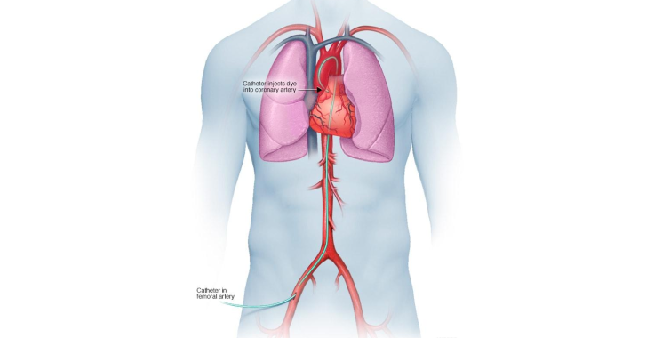 Angiogram Procedure in Bangalore | Manipal Hospitals