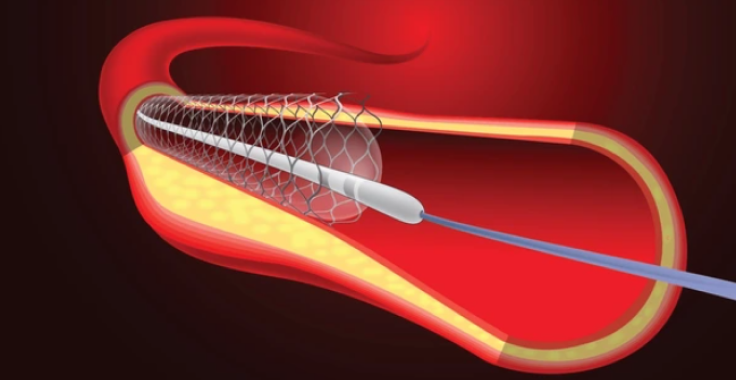 Angioplasty in Manipal Hospital | Bangalore