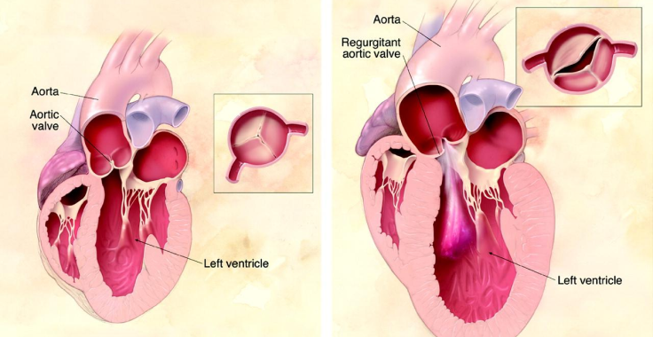 Aortic Valve Repair And Aortic Valve Replacement | Manipal Hospitals