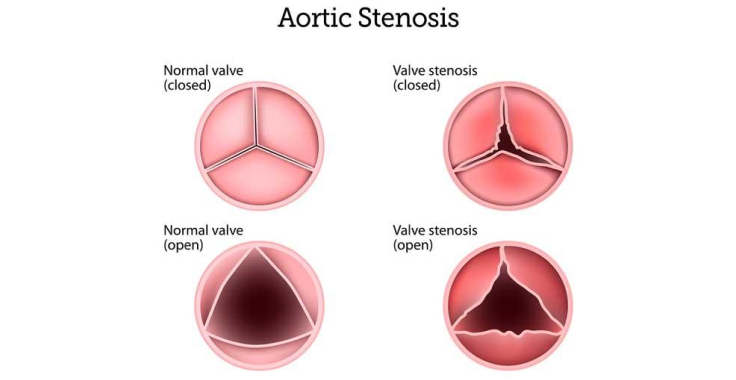 Transcatheter Aortic Valve Implantation | Manipal Hospitals