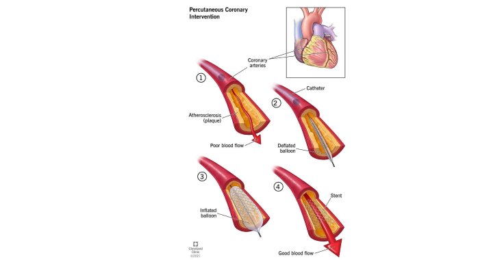 Percutaneous Transluminal Coronary Angioplasty