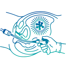 Brachytherapy Treatment in India | Manipal Hospitals