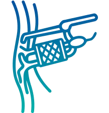 Carotid Doppler Test in Delhi | Manipal Hospitals