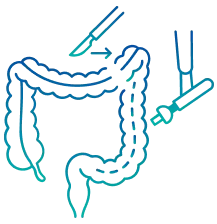 Colectomy Surgery in India | Manipal Hospitals
