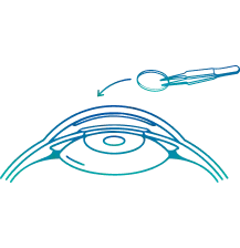 Corneal Transplant Surgery in India | Manipal Hospitals