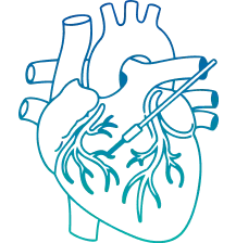 Coronary Angiography Test in Delhi | Manipal Hospitals