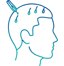 Hair Transplant Surgery in Pune | Manipal Hospitals