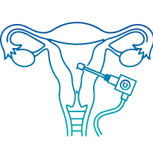 Hysterectomy in Pune | Manipal Hospitals