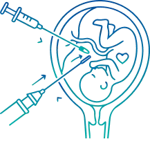 Intrauterine Insemination (IUI) in India | Manipal Hospitals
