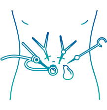 Laparoscopic Cholecystectomy in Pune | Manipal Hospitals