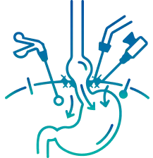 Laparoscopic Hernia Surgery in Bangalore | Manipal Hospitals