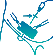 Laparoscopic Hernia Surgery in Bangalore | Manipal Hospitals