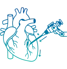 Minimally Invasive Heart Surgery in India | Manipal Hospitals