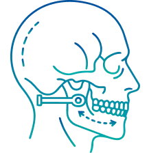 Orthognathic Surgery in Delhi | Manipal Hospitals