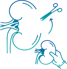 Nephrectomy Surgery in India | Manipal Hospitals