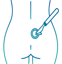 Pilonidal Sinus Surgery in Pune | Manipal Hospitals