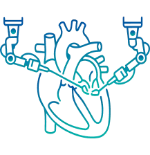 Robotic Mitral Valve Surgery in India | Manipal Hospitals