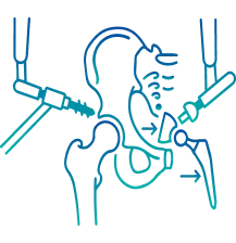 Robotic Hip Replacement Surgery in India | Manipal Hospitals