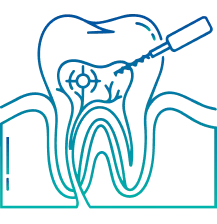 Root Canal Treatment in Pune | Manipal Hospitals