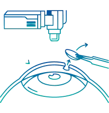SMILE Eye Surgery in India | Manipal Hospitals