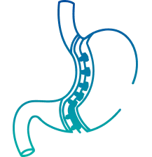 Sleeve Gastrectomy in Pune | Manipal Hospitals