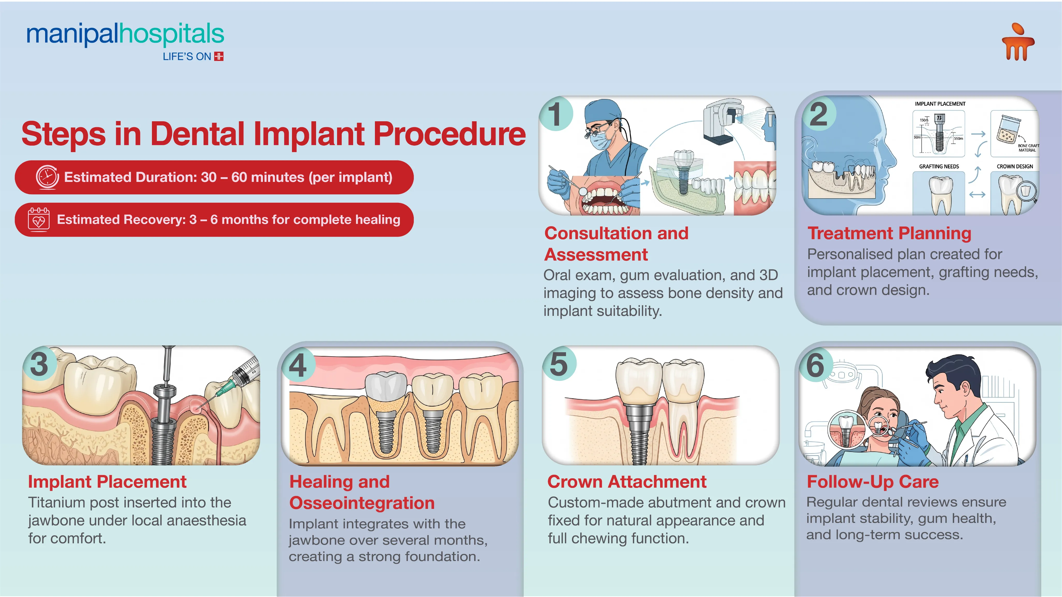 Dental Implants in Delhi | Manipal Hospitals