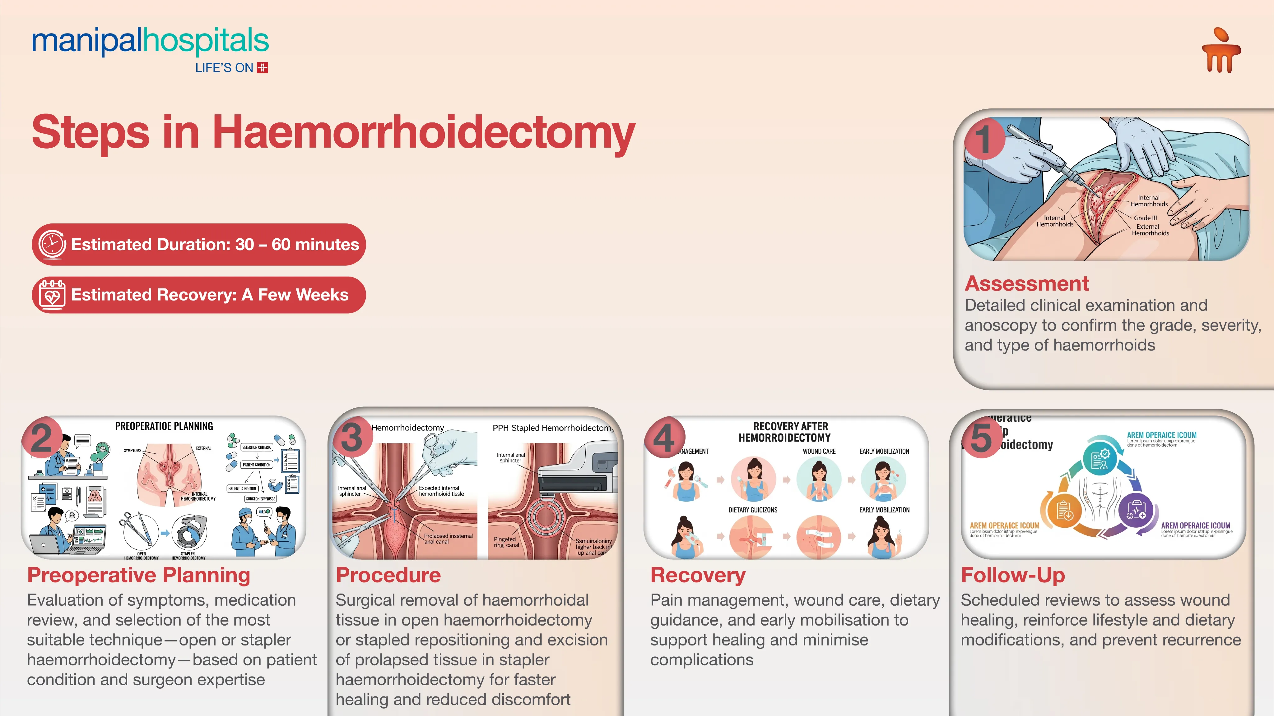 Hemorrhoidectomy Surgery in India | Manipal Hospitals