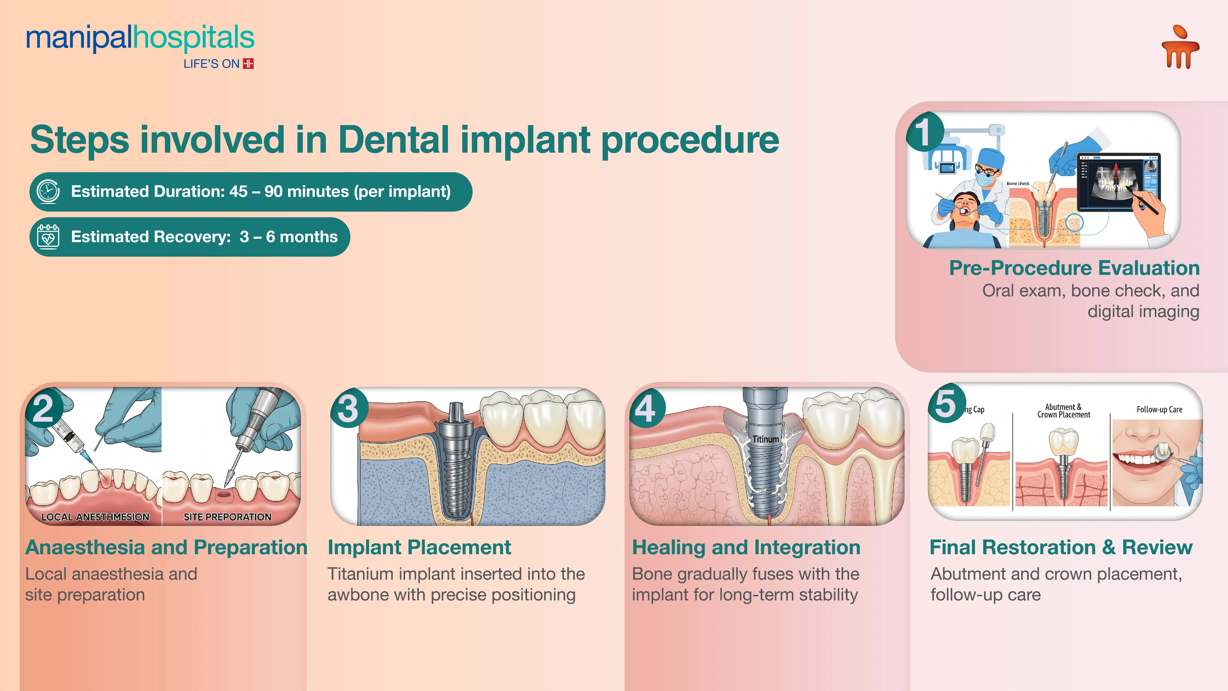Dental Implants in Pune | Manipal Hospitals